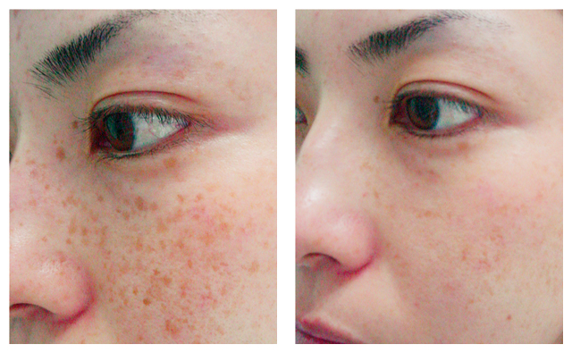 Brown Spot Removal Before & After