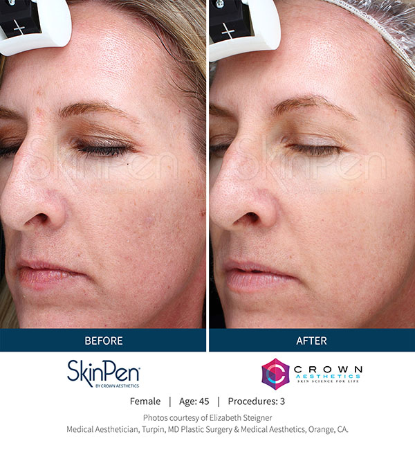 MicroNeedling Before & After