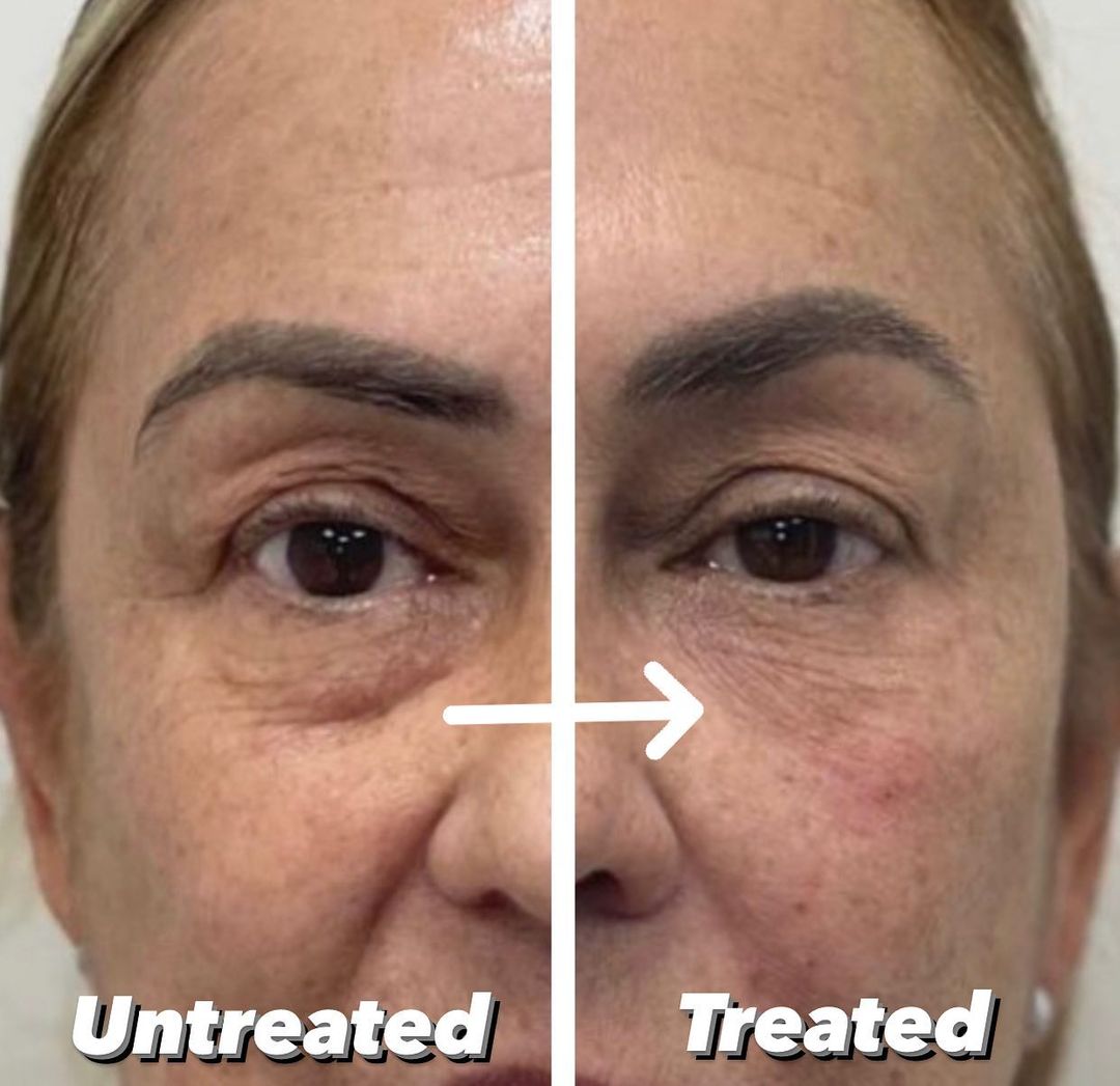 Belotero before and after photo by IconMD Medical Spa + Laser Center in Boca Raton, FL
