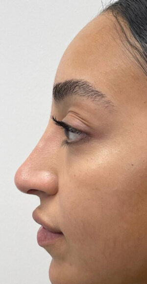 Non-Surgical Nose Job