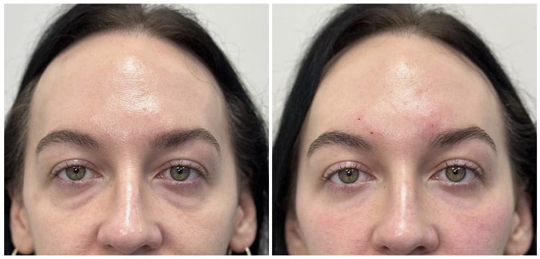 RHA Fillers | Boca Raton, FL | Icon MD