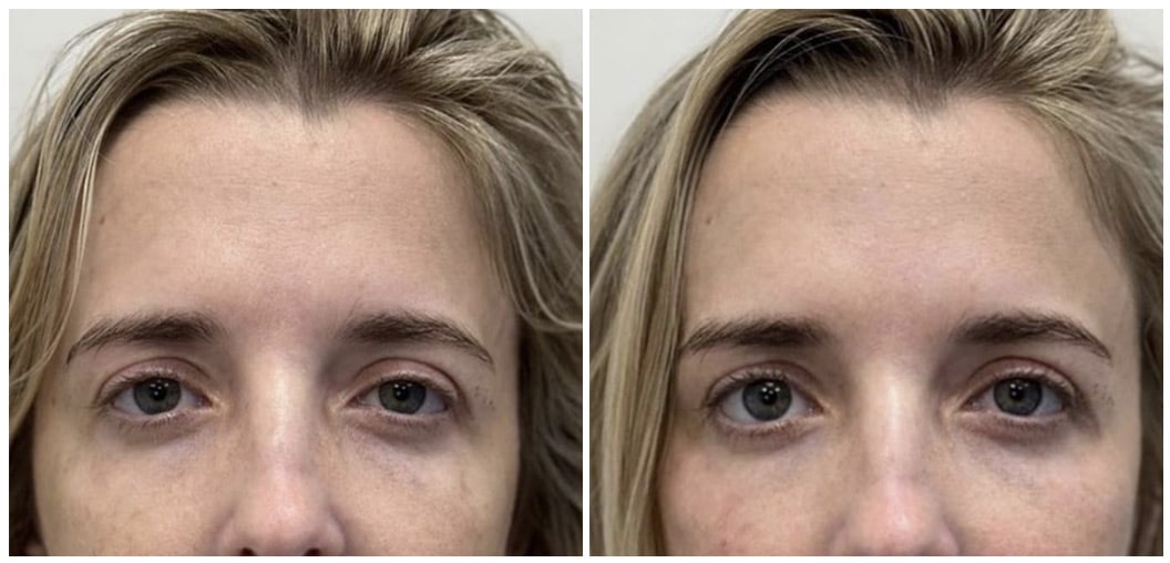 RHA Fillers | Boca Raton, FL | Icon MD